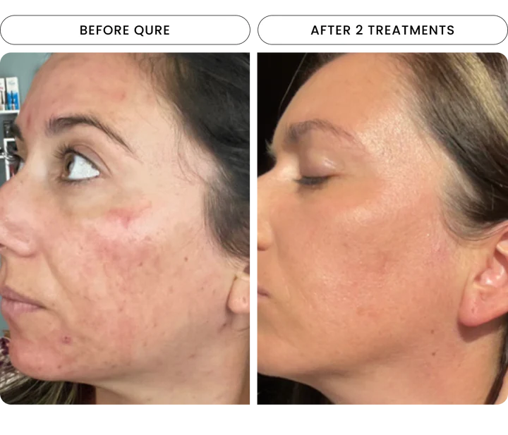 Micro-Infusion 2 Month Bundle (For Wrinkles + Dark Spots)