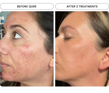 Micro-Infusion 2 Month Bundle (For Wrinkles + Dark Spots)